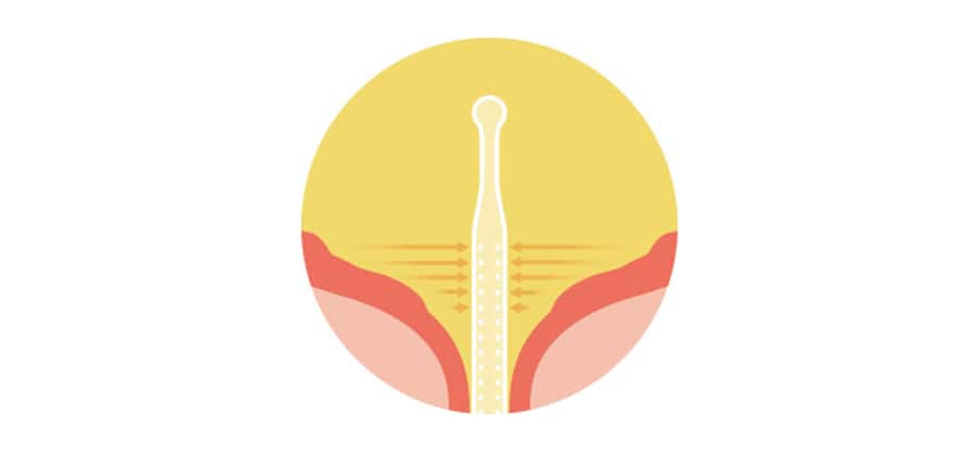 Schéma d'un cathéter Luja à l'intérieur de la vessie. La technologie Micro-hole Zone de Luja est conçue pour drainer l'urine depuis le fond de la vessie et permettre un écoulement libre et ininterrompu de l'urine. 